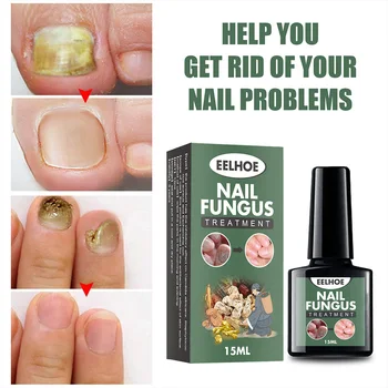 cum să vindeci unghiile fungice)